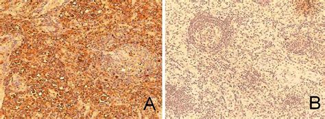 Immunohistochemistry Findings A Cervical Lymph Node Biopsy Specimen Download Scientific