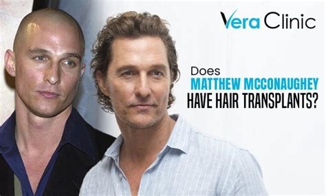 Matthew McConaughey Hair Transplant - Vera Clinic