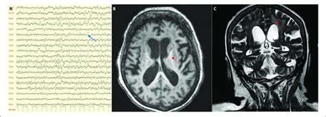 A Eeg Showing A Slow Alpha With Theta And Delta Activity Blue