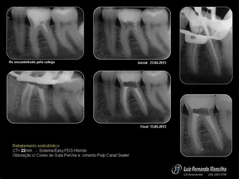 Canal Mancilha Retratamento Endodôntico Sistema Prodesign Duo Hibrido