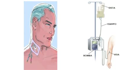 Sonda Enteral E Parenteral - Nutrição Enteral e Parenteral: Conheça as Diferenças