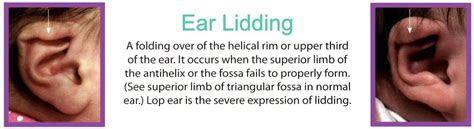 Ear Lidding Treatment | NYC and Trumbull, CT | Ears R Us