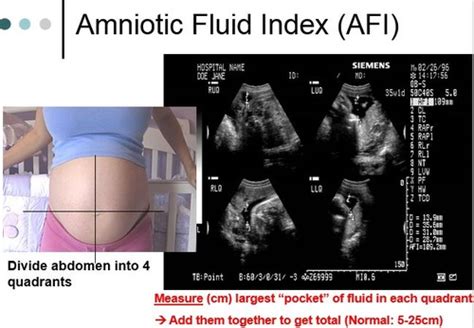 Amniotic Fluid And Afi Flashcards Quizlet