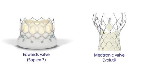 Tavi Transcatheter Aortic Valve Implantation Sa Heart