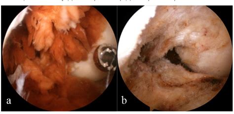 Figure From Treatment Of Primary Intra Articular Pigmented