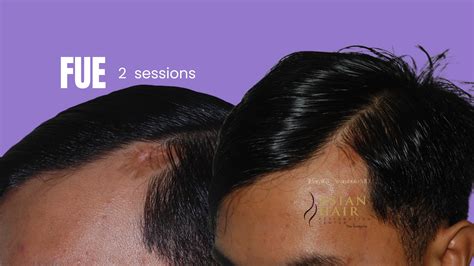 Hair Transplant In Scar Tissue Our Authentic Results Speak