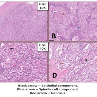 A Microscopic Picture Of Biphasic Synovial Sarcoma 10X Spindle Cell