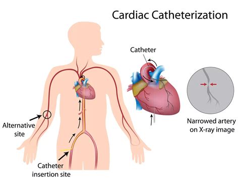 Groin Hematoma After Cardiac Catheterization Lady And Care