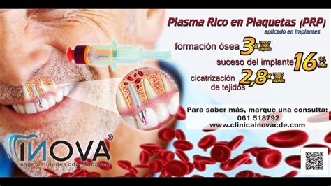 Plasma Rico En Plaquetas Aplicado En Implantes Dentales YouTube