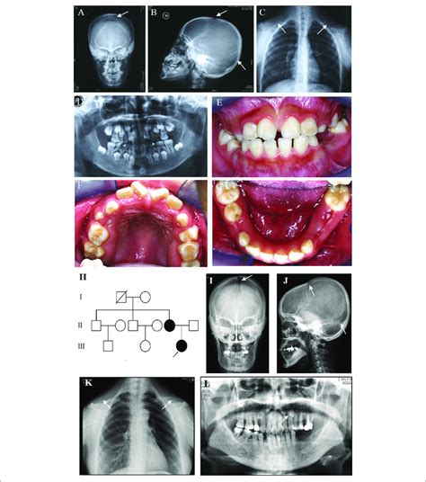 Clinical And Radiographic Findings Of The Proband And Her Affected