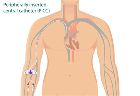 Liver Cancer Treatments Central Venous Access Devices