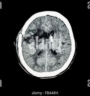 Una Tomograf A Computarizada Del Cerebro Mostrar Vieja Derecha