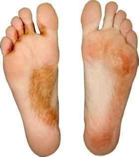 Podiatrist In El Monte Athlete S Foot In El Monte Payman Hoshyarsar