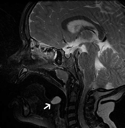 Congenital Oral Masses An Anatomic Approach To Diagnosis Radiographics