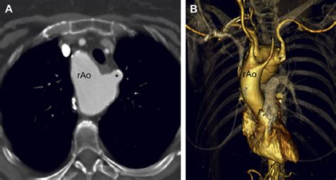 Right Aortic Arch With Aberrant Left Subclavian Artery A Axial Ct