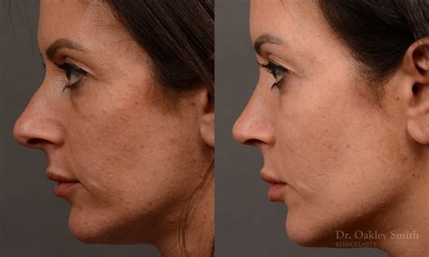 Rhinoplasty Before And After Case 495 Toronto Rhinoplasty Surgery