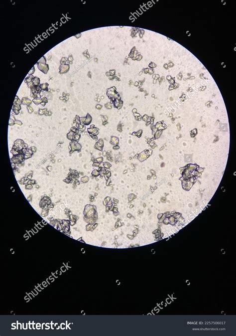 Microscopic View Struvite Crystals Urinary Sediment Stock Photo ...