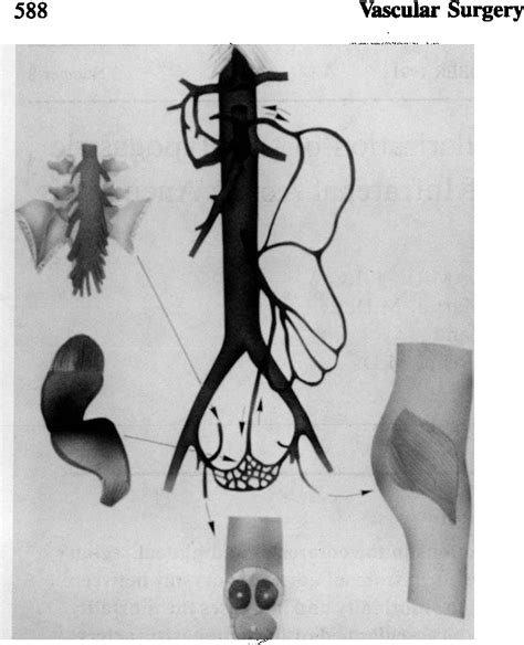 Figure 1 From Importance Of The Revascularization Of The Hypogastric