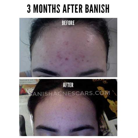 Results from Banish and my Struggle With Acne