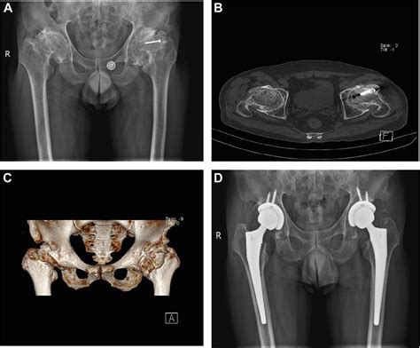 Conversion Total Hip Arthroplasty After Pedicled Peri Hip Bone Flap