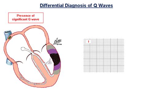 Differential Diagnosis of Q Waves – Medical GIF