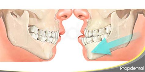 Consideraciones Oclusales En Implantes Dentales