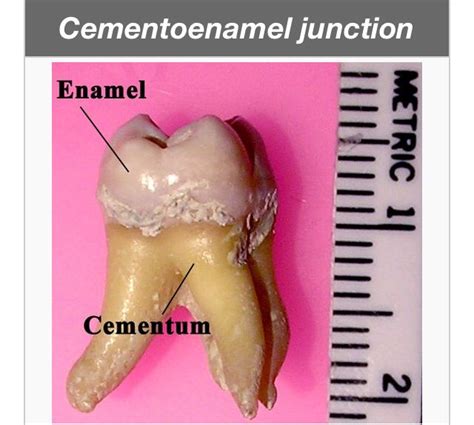 Cementoenamel Junction Tooth Enamel Dentistry Teeth Bleaching