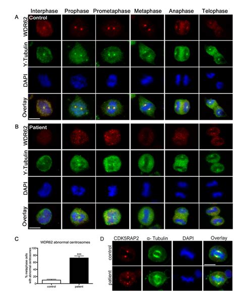 Wdr62 In Immortalized Lymphocytes And Dispersion Of Centrosomal