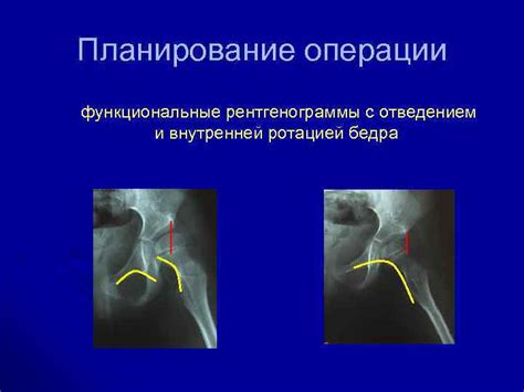Реконструктивные операции на тазобедренном суставе в системе лечения
