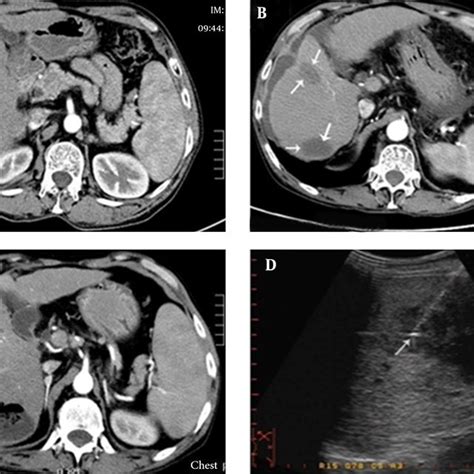 Patient With Child Pugh Class C Cirrhosis Who Underwent Mwa Treatment