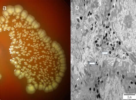 Figure 2 From Cellulitis And Bacteria In Peripheral Lymphedema Semantic Scholar