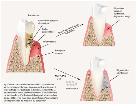 Int R Ts Des Exosomes Dans La R G N Ration Osseuse Et Parodontale L