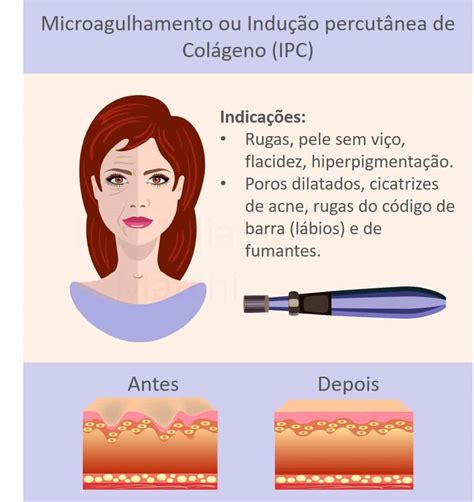 Microagulhamento Sandra Martins Inducao Percutanea Colageno Protocoll