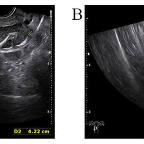 Three−dimensional Transvaginal Ultrasound A Transvaginal Ultrasound Download Scientific