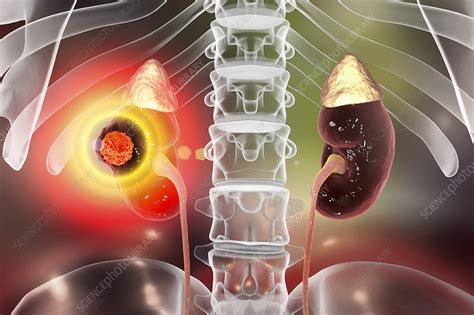 Kidney cancer treatment, conceptual illustration - Stock Image - F021 ...