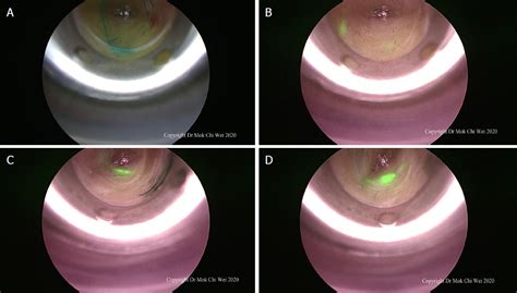 Endoscopic Assisted Icg Easi Technique For Sentinel Lymph Node Biopsy