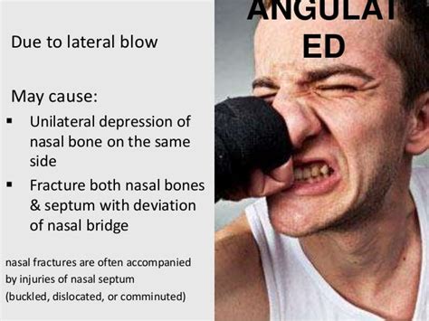 Distal Nasal Fracture