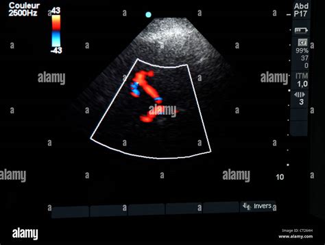 L ultrasonographie Doppler transcrânienne Banque D Images Photo Stock
