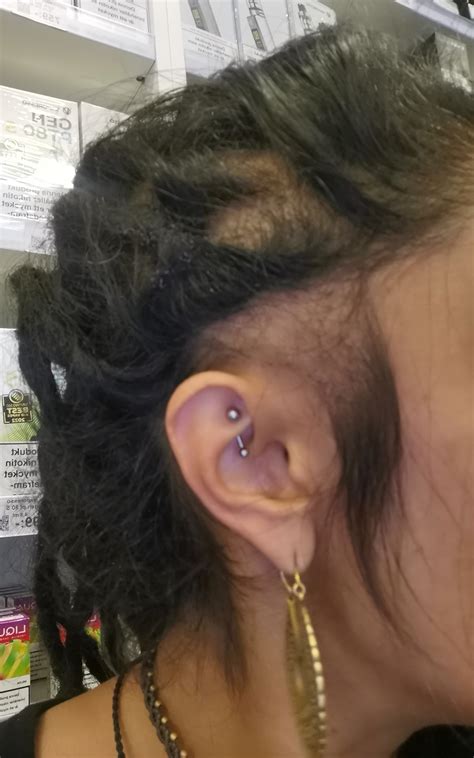 Traction alopecia help : r/Dreadlocks