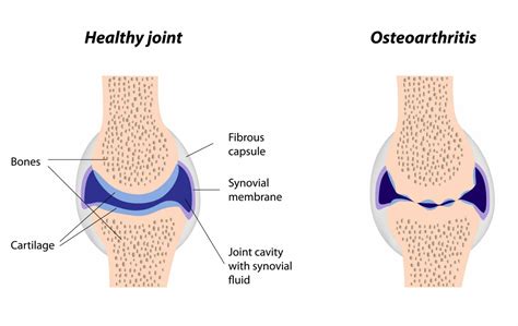 Synovial Joint Normal And Arthritis Physio Logical