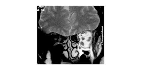 Silent Sinus Syndrome The Elza Institute