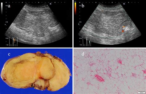 Sonographic Appearances Of Liposarcoma Correlations With Pathologic