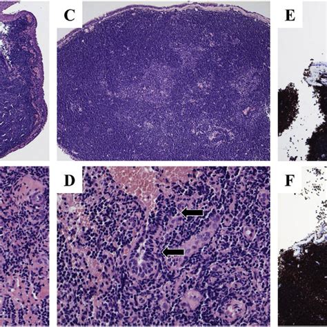 A Histological Findings From The Palpebral Conjunctival Lesion