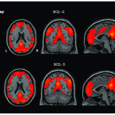 ReHo And ALFF Values Vary With BCQ Subscores In All Healthy Adults N