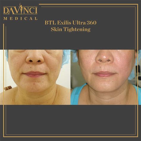 Da Vinci Clinic Facelift Face Contouring Using Btl Exilis Ultra