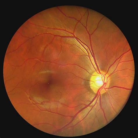 Hfc 01 Handheld Ophthalmic Product Digital Retinal Eye Non Mydriatic