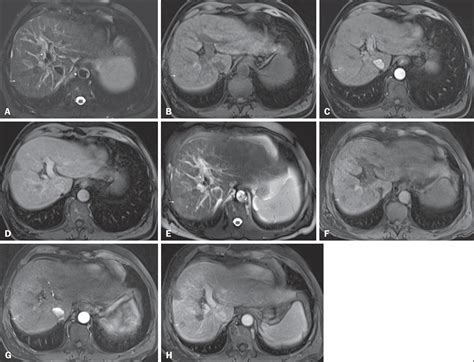 Scielo Brazil Magnetic Resonance Imaging Of The Cirrhotic Liver