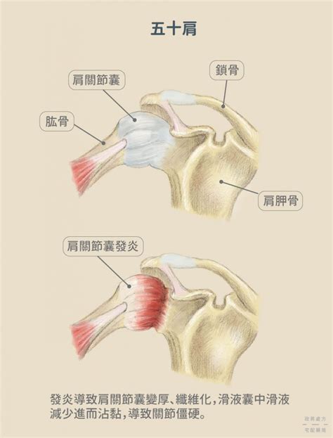 五十肩有這些症狀！3種幫助恢復的復健運動