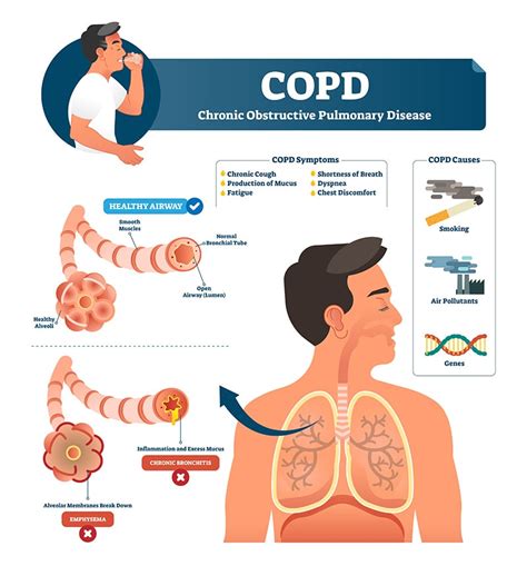 COPD - Never take a single breath for granted. - St. Clair Health Blog