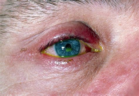 Corneal Abrasion Fluorescein